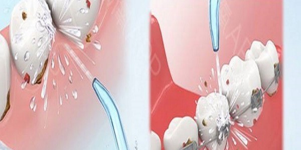 醫(yī)用超聲波洗牙機好用嗎