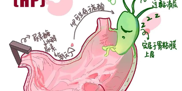 【必看】幽門螺桿菌真相揭示，別再忽視你的胃痛了！