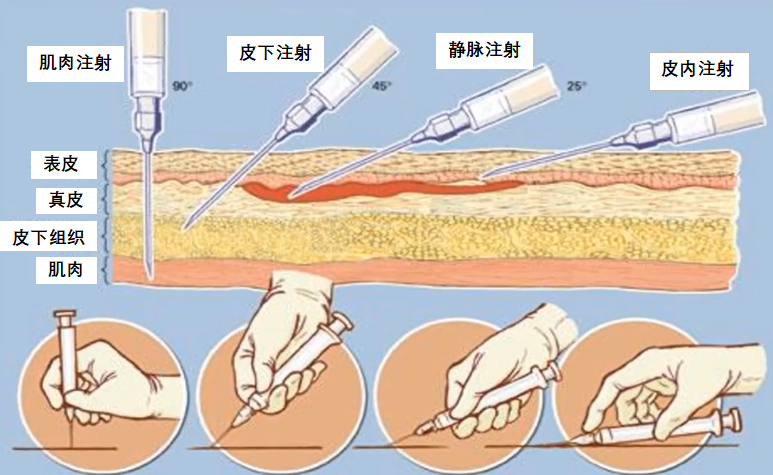 用注射器打針時(shí)傷神經(jīng)怎么辦