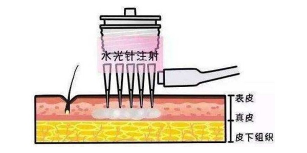 自己打水光針會(huì)導(dǎo)致面癱嗎